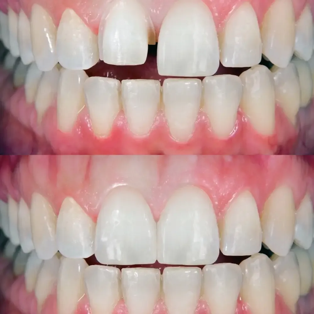Before and after porcelain veneers at our Toowoomba practice